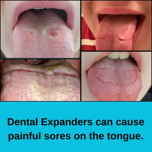 Vista 3 de Protector de lengua EP: previene y ayuda a curar las llagas de la lengua causadas por expansores dentales