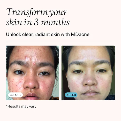 Vista 3 de MDacne Kit de Tratamiento Facial para Acné en 3 Pasos, Crema de Peróxido de Benzoilo 2.5%, Limpiador de Ácido Salicílico, Hidratante de Niacinamida