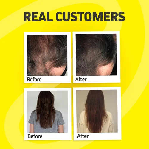 Vista 4 de Vitaminas para el crecimiento del cabello para mujeres y hombres Bloqueador DHT con palma enana americana y 10000 mcg de biotina, suplemento