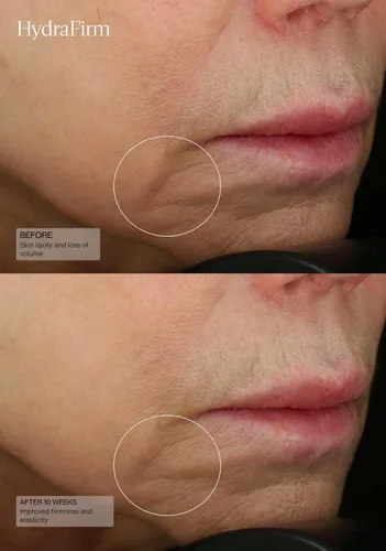 Vista 6 de Senté HydraFirm Serum Apoya la producción de colágeno y elastina Restaura la firmeza y rellena la piel Formulado con HSA y péptidos patentados