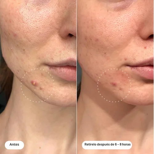 Vista 3 de Mighty Patch™ Invisible+ Patch - Parches hidrocoloides para acné invisibles de día para cubrir espinillas y marcas, pegatinas ultra finas para cara
