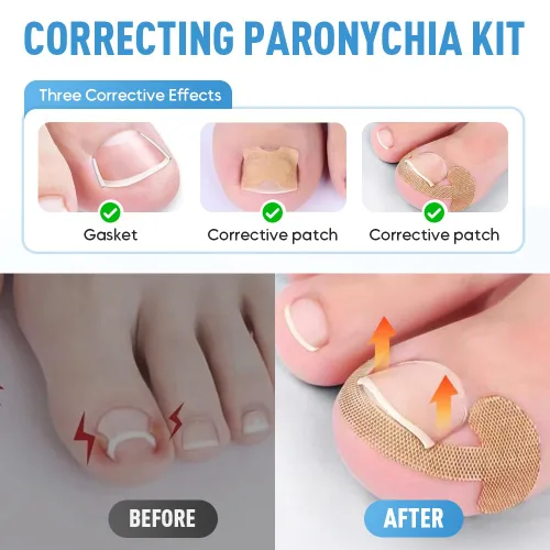 Vista 6 de Kit de tratamiento de uñas encarnadas, tiras correctoras transpirables y herramientas de pedicura sin dolor, parche corrector de uñas profesional