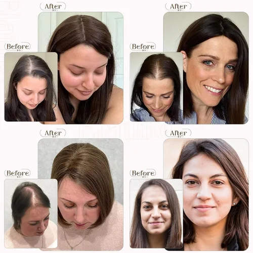 Vista 5 de Elailite Toppers para el cabello para mujer, cabello humano real, separación libre para adelgazar el cabello, piezas de cabello para pérdida