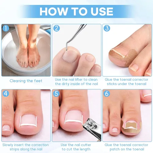 Vista 4 de Kit de eliminación de uñas encarnadas con tiras de uñas encarnadas, parche corrector de uñas curvas, lima de uñas y herramientas de pedicura