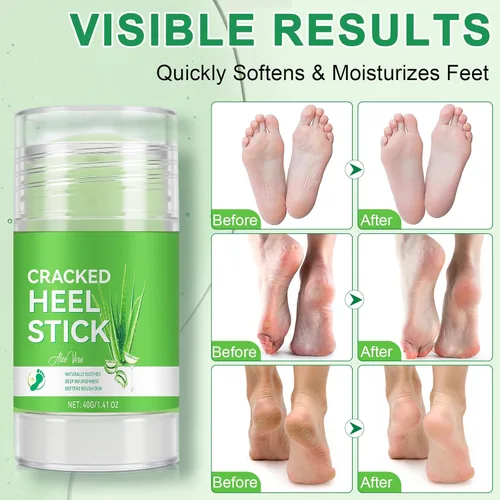 Vista 5 de Crema de urea removedor de callos para pies, 60% de urea con 2% de ácido salicílico, hidratante de fuerza profesional para pies agrietados secos