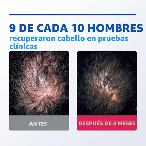 Vista 5 de Rogaine para hombres 5% minoxidil espuma tópica, suministro para un mes