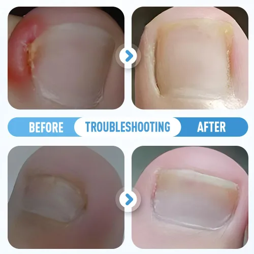 Vista 5 de Kit de tratamiento de uñas encarnadas, tiras correctoras transpirables y herramientas de pedicura sin dolor, parche corrector de uñas profesional