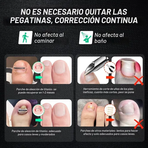Vista 2 de Tratamiento de uñas encarnadas de aleación de titanio, herramientas de uñas y kit de eliminación de uñas encarnadas especialmente diseñado