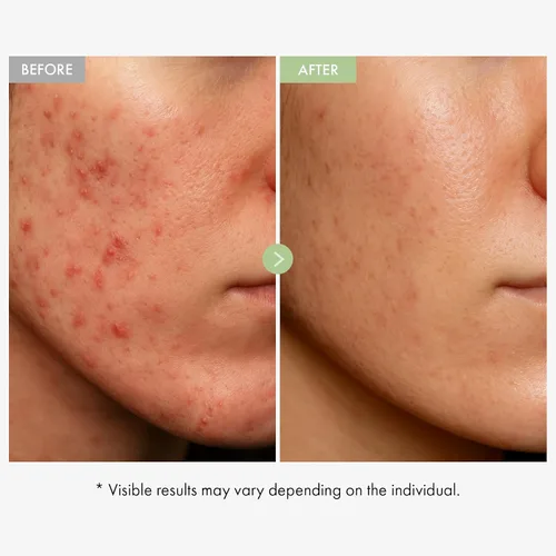 Vista 3 de TOSOWOONG Exosome CICA Crema Facial - Hidratante diario calmante para brotes y piel irritada, acción rápida, ligera para el cuidado de la piel