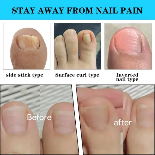 Vista 3 de (50+1) Juego de corrector de uñas encarnadas, kit profesional de eliminación de uñas encarnadas sin dolor con levantador de uñas de los pies, tira