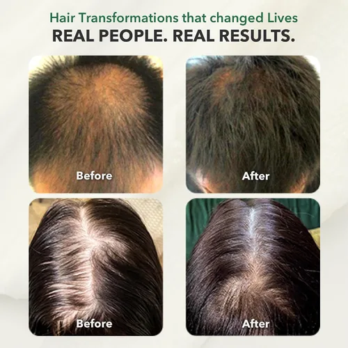 Vista 6 de H5 Grow+ Suplemento vitamínico para el cabello, biotina, hierbas ayurvédicas y 5 grupos de nutrientes para el crecimiento, densidad y fuerza