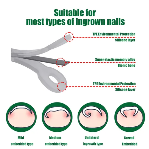 Vista 5 de Corrector de uñas encarnadas de titanio, herramientas de reparación de uñas, tratamiento de uñas encarnadas, adecuado para la mayoría