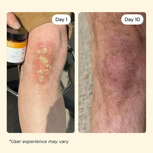 Vista 4 de MyMagicHealer Universal Flare Care Sin aceite esencial Alivio para erupciones, eczema, psoriasis, hidradenitis supurativa, impétigo, dermatitis
