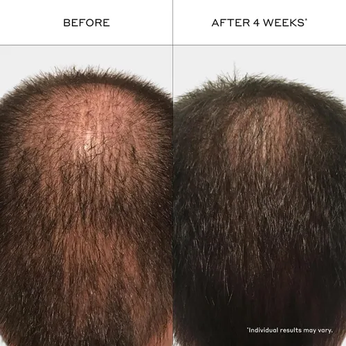 Vista 4 de Zenagen Revolve - Tratamiento de pérdida de cabello para hombres