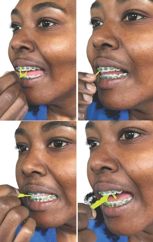 Vista 6 de Braces Cepillo de dientes recargable con 4 cabezales Bonus 2
