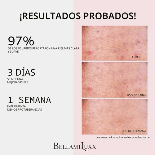 Vista 2 de BellamiLuxx Crema de tratamiento para eliminar el acné de los glúteos: Tratamiento del acné corporal para foliculitis y espinillas en glúteos
