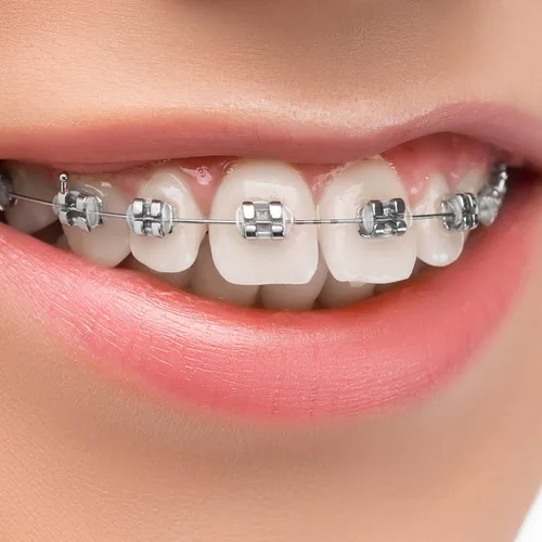 Vista 3 de Annhua Lazos dentales de ligadura de ortodoncia 1040 piezas, bandas de color Ortho Braces Ligadura Lazos elastoméricos O-Rings - Transparente