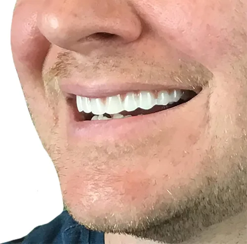 Vista 3 de Instant Smile Ajuste Cómodo Flex Tono Natural