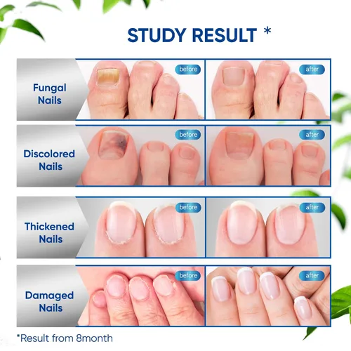 Vista 4 de Tratamiento de hongos para uñas de los pies, tratamiento de hongos en las uñas de los pies, extra fuerte, tratamiento de hongos en las uñas