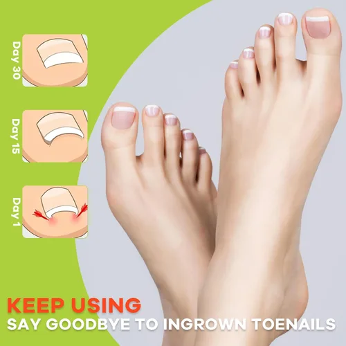 Vista 4 de Kit corrector de uñas encarnadas, herramientas de uñas, tiras de corrección transpirables con herramientas de levantamiento de uñas, cortaúñas