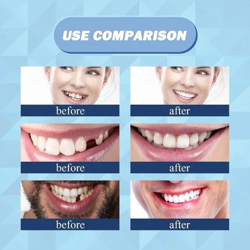 Vista 7 de Kit de reparación de dientes de 1.0 fl oz, kit de reemplazo de dientes temporales – Perlas moldeables de ajuste térmico para rellenar dientes