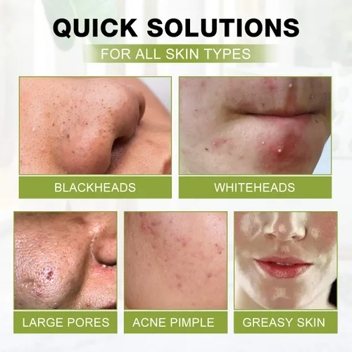 Vista 5 de SHVYOG Máscara Facial de Puntos Negros, Máscara Removedora de Puntos Negros 3-en-1 con Cepillo y Suero de Aceite de Árbol de Té, Máscara de Carbón