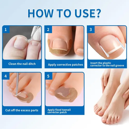 Vista 2 de Kit de eliminación de uñas encarnadas, 50 tiras correctoras de uñas encarnadas sin dolor con levantador de uñas de los pies, lima sin dolor, kit