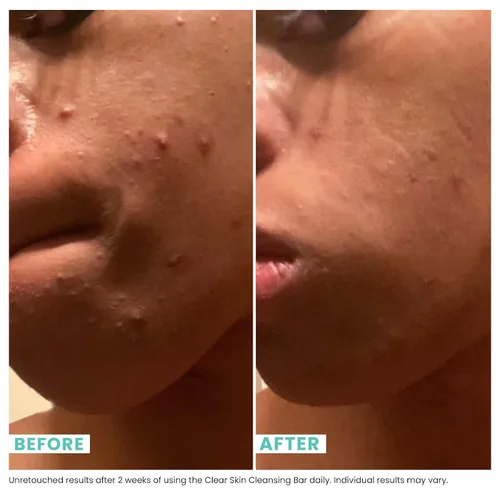 Vista 5 de Urban Skin Rx Clear Skin - Barra limpiadora de tratamiento diario 3 en 1, exfoliante + máscara aclaradora, reduce el exceso de aceite, limpia