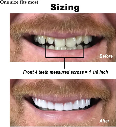 Vista 9 de Instant Sonrisa Comfort Flex, nuevo. Talla única. Arregla tu sonrisa en casa en cuestión de minutos. 5 Minutos adulto Makeover, Upper revestimiento