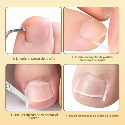 Vista 9 de Juego de corrector de uñas encarnadas con lupa y tiras correctoras, juego de herramientas profesionales de tratamiento de uñas encarnadas, cuidado