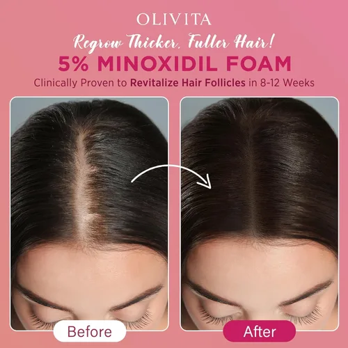 Vista 2 de 5% de espuma de minoxidil para el crecimiento del cabello de las mujeres: tratamiento de crecimiento del cabello extra fuerte - Solución de pérdida