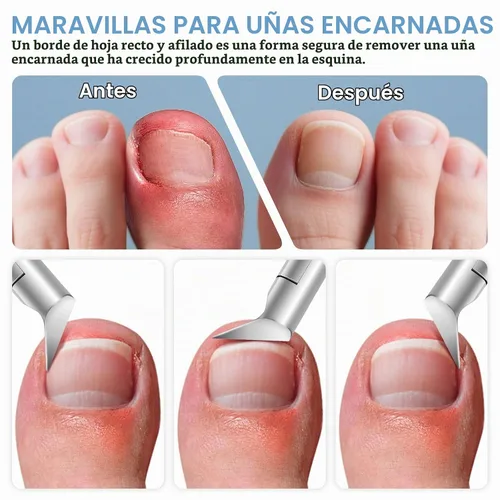 Vista 2 de Kit de eliminación de uñas encarnadas (1 unidad)