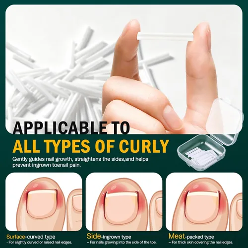 Vista 2 de FVION Juego de corrector de uñas encarnadas – 40 tiras alisadoras de uñas encarnadas sin dolor con levantador de uñas de los pies – Solución eficaz