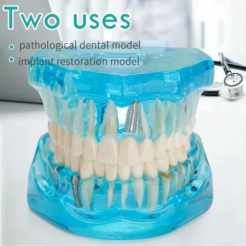 Vista 2 de Modelo de dientes de implante dental transparente - Modelo de dientes de enfermedad transparente Modelo de dientes patológicos con dientes