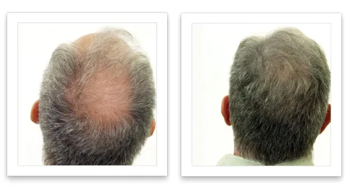Vista 2 de Ocultador de pérdida del cabello Caboki (Restaura las fibras del cabello)
