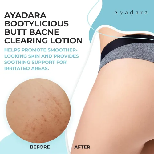 Vista 4 de Loción y crema para eliminar el acné de glúteos, 8 onzas con ácido salicílico, crema suavizante para glúteos y loción limpiadora para mujeres