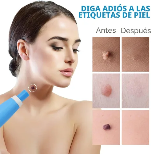 Vista 3 de Dispositivo Removedor de Verrugas Cutáneas Aprobado por la FDA Seguro y Efectivo Kits de Eliminación de Verrugas Cutáneas para Uso Doméstico