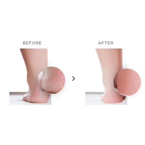Vista 3 de Nu119 Platinum Instant Foot Peel Spray - Exfoliante y removedor de callos para talones y pies secos y agrietados - Solución de exfoliación de piel