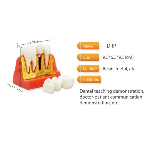 Vista 2 de Modelo de dientes dentales D-IP, modelo de dientes de implante dental transparente Dentista Enfermedad estándar Diente extraíble Modelo de enseñanza