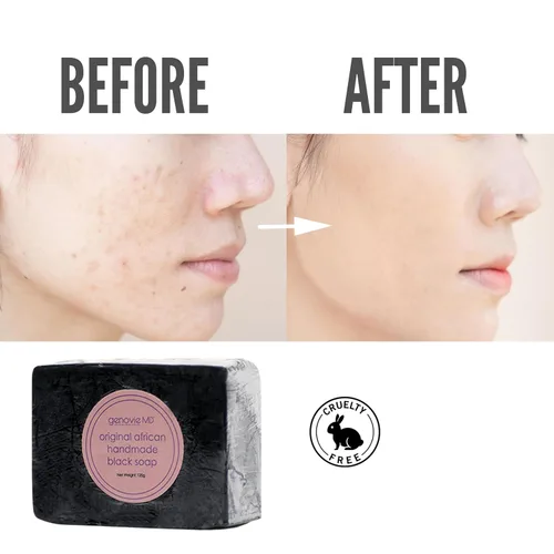 Vista 6 de genovie MD Jabón negro africano original, barra de jabón facial y corporal para mujeres, jabón negro para el acné, lavado de piel seca y piel