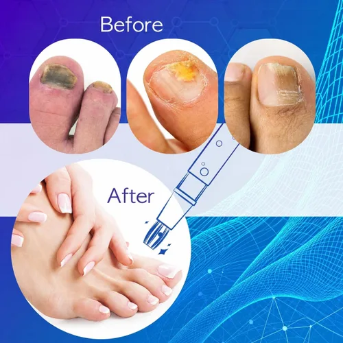Vista 5 de Bolígrafo antifúngico para uñas, bolígrafo para hongos de las uñas de los pies, tratamiento para hongos de las uñas para uñas de los pies