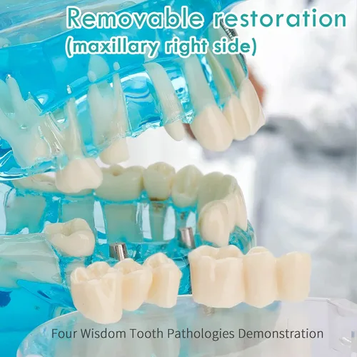 Vista 3 de Modelo de dientes de implante dental transparente - Modelo de dientes de enfermedad transparente Modelo de dientes patológicos con dientes