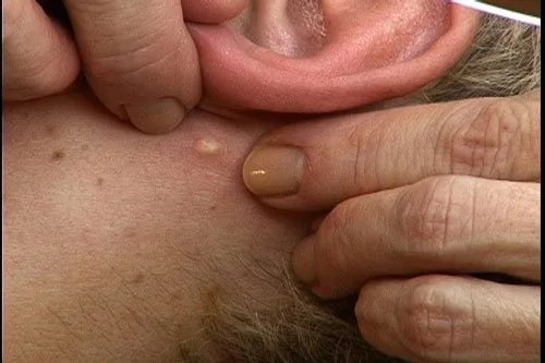 Vista 4 de Facial Techniques For Treating Acne DVD - Learn How to Clear & Heal Acne Prone Skin - Esthetician Training Video For Acne Extractions and Deep Pore