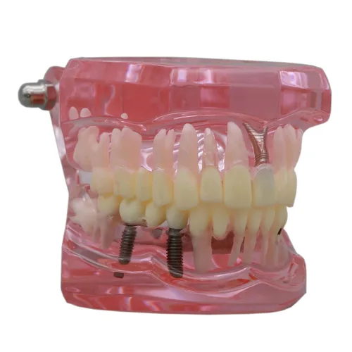 Vista 4 de Demostración oral del puente de la patología del color rosado de los dientes de Typodont de la restauración del implante dental M2001