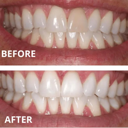 Vista 4 de Gel blanqueador dental extremo 44% (6 geles)