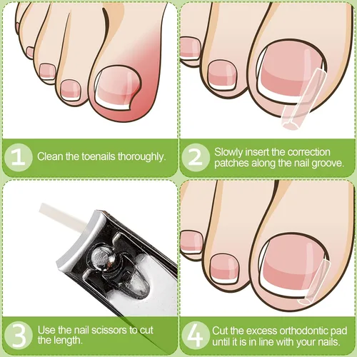 Vista 4 de 100 tiras correctoras de uñas encarnadas, parches de corrección de uñas de los pies, parches curvos para enderezar las uñas de los pies, clips