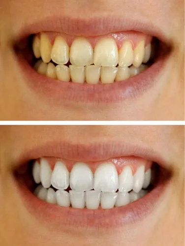 Vista 8 de Dispensadores de jeringas de gel blanqueador de dientes 22% de peróxido de carbamida, 10 jeringas de gel blanqueador de dientes de 0.1 fl oz