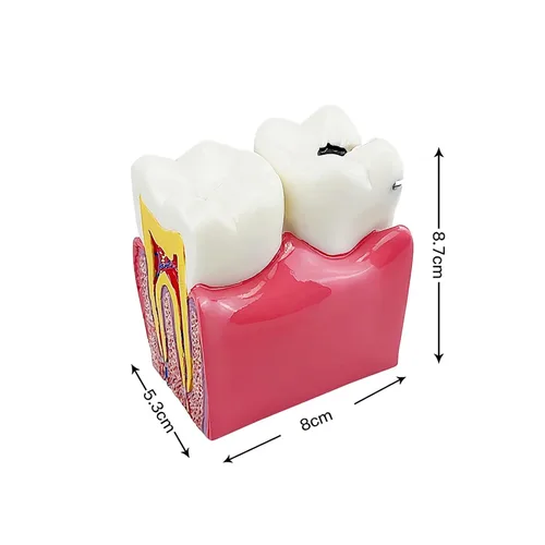 Vista 3 de Modelo de dientes de caries dental, modelo YOUYA DENTAL 6 veces de dientes de caries modelo de anatomía dental para educación de dientes