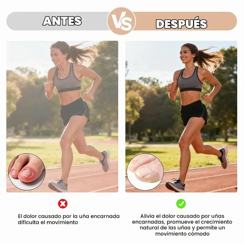 Vista 5 de 100 tiras correctoras de uñas encarnadas, tratamiento de uñas encarnadas, alivio del dolor para uñas curvas, herramienta de corrección de uñas