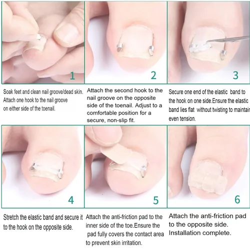 Vista 4 de Kit corrector de uñas encarnadas para hombres y mujeres, herramienta de uñas encarnadas, 2 clips de acero inoxidable, tiras de uñas curvas